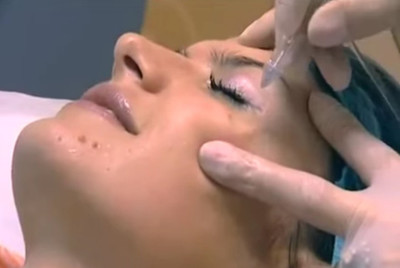 Выпрямление носа после перелома в казани