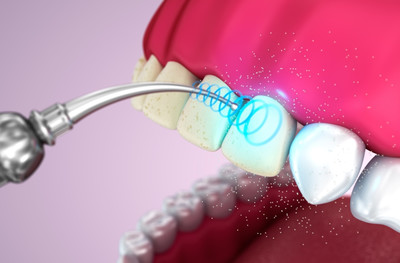 Ультразвуковая чистка зубов от налета и зубных отложений
